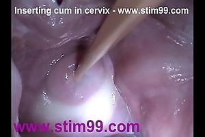 Insertion semen cum concerning cervix with respect to flourishing wet crack reflector